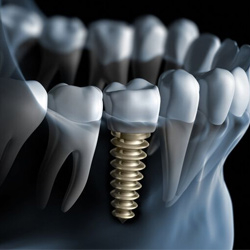 dental-implants-plano-texas-home